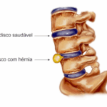 Tratamento Fisioterapêutico Inovador para Reabsorção da Hérnia de Disco Lombar.