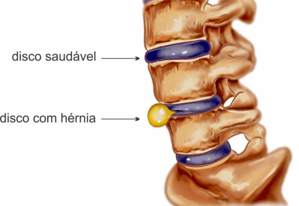 hernia-de-disco-foto-1024x930